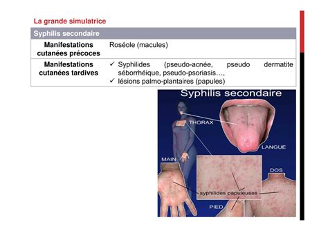 Sexe oral et risque dinfections sexuellement transmissibles,